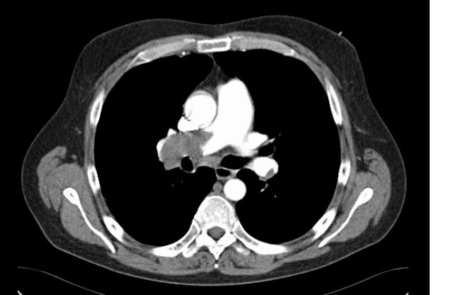 comment soigner embolie pulmonaire